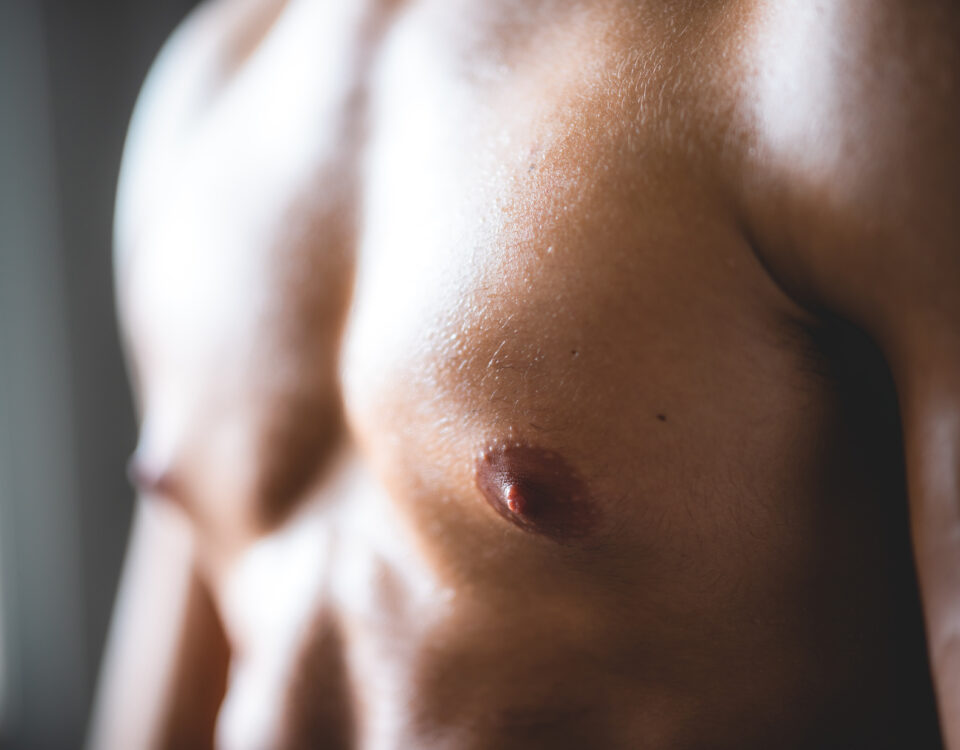 gynecomastia surgery SA