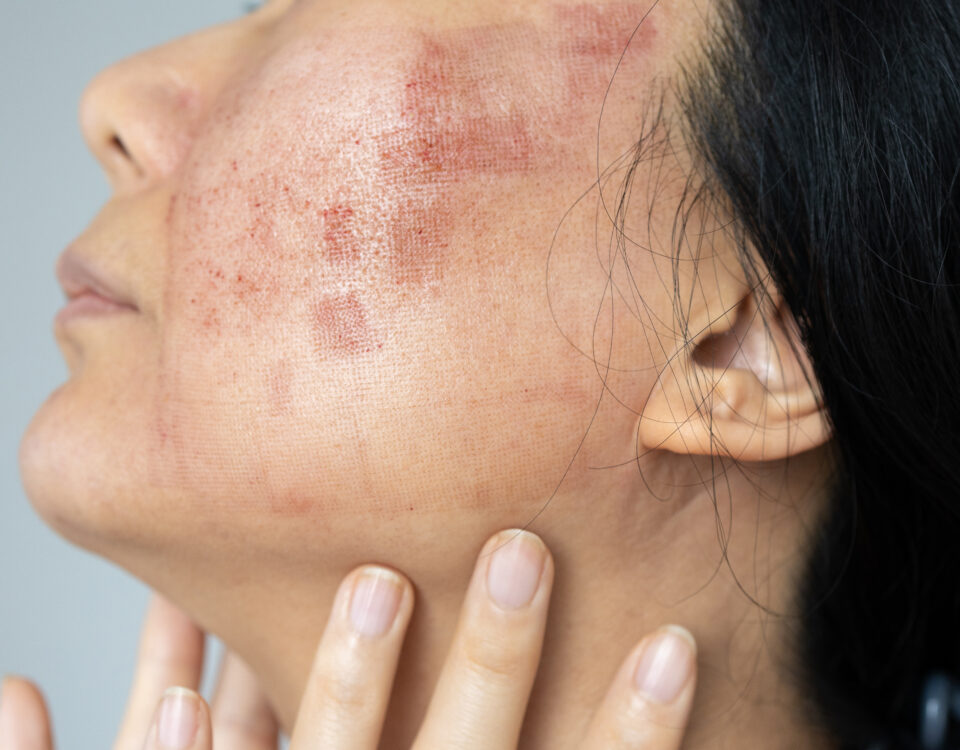 burn reconstruction South Africa